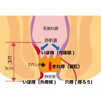 ママ世代に“痔主”が増えている!?