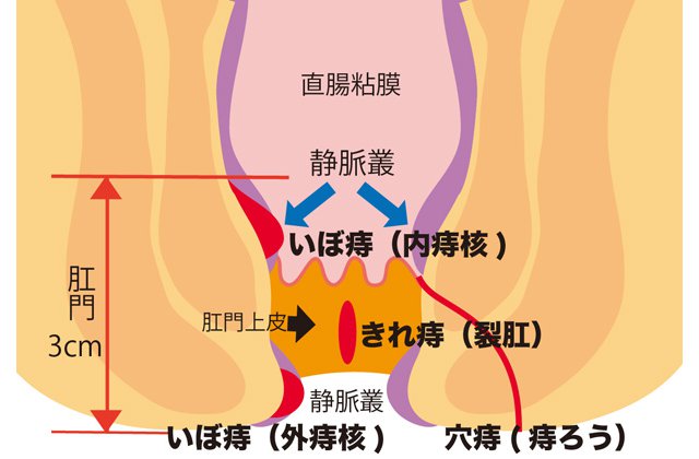 ママ世代に“痔主”が増えている!?