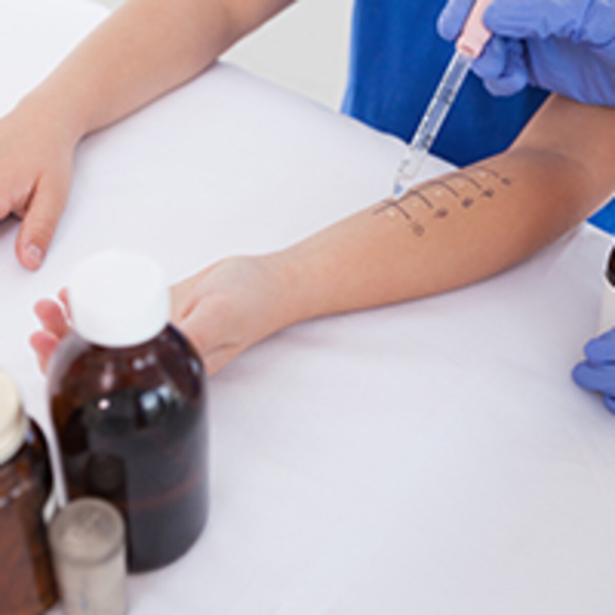 食物アレルギーの検査って何をするの？