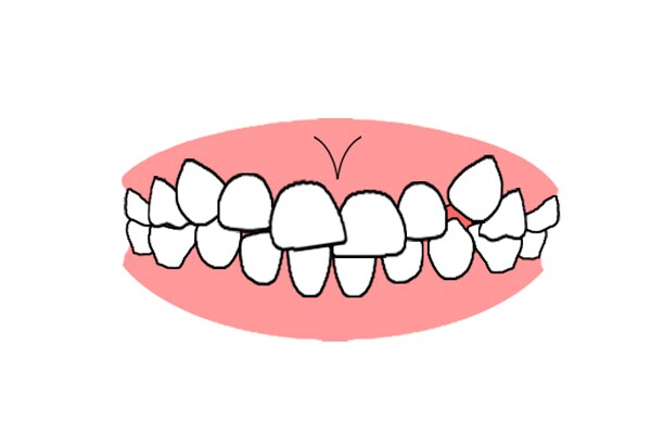 デコボコ歯並びイラスト