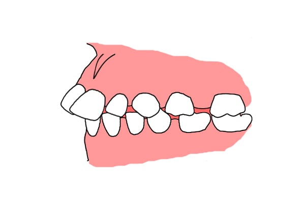出っ歯のイラスト