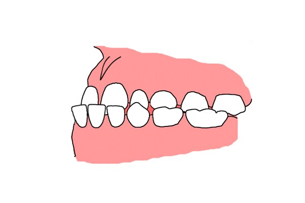 受け口のイラスト