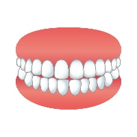 子どもに多い歯並びトラブル