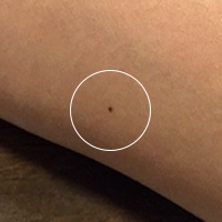 ドラッグストアで買える！ほくろ除去に役立つお灸やクリームの使い方