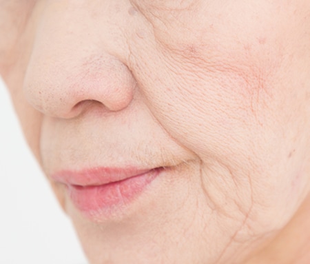 ほうれい線には「サージカルテープ」が効果的!正しい貼り方は?