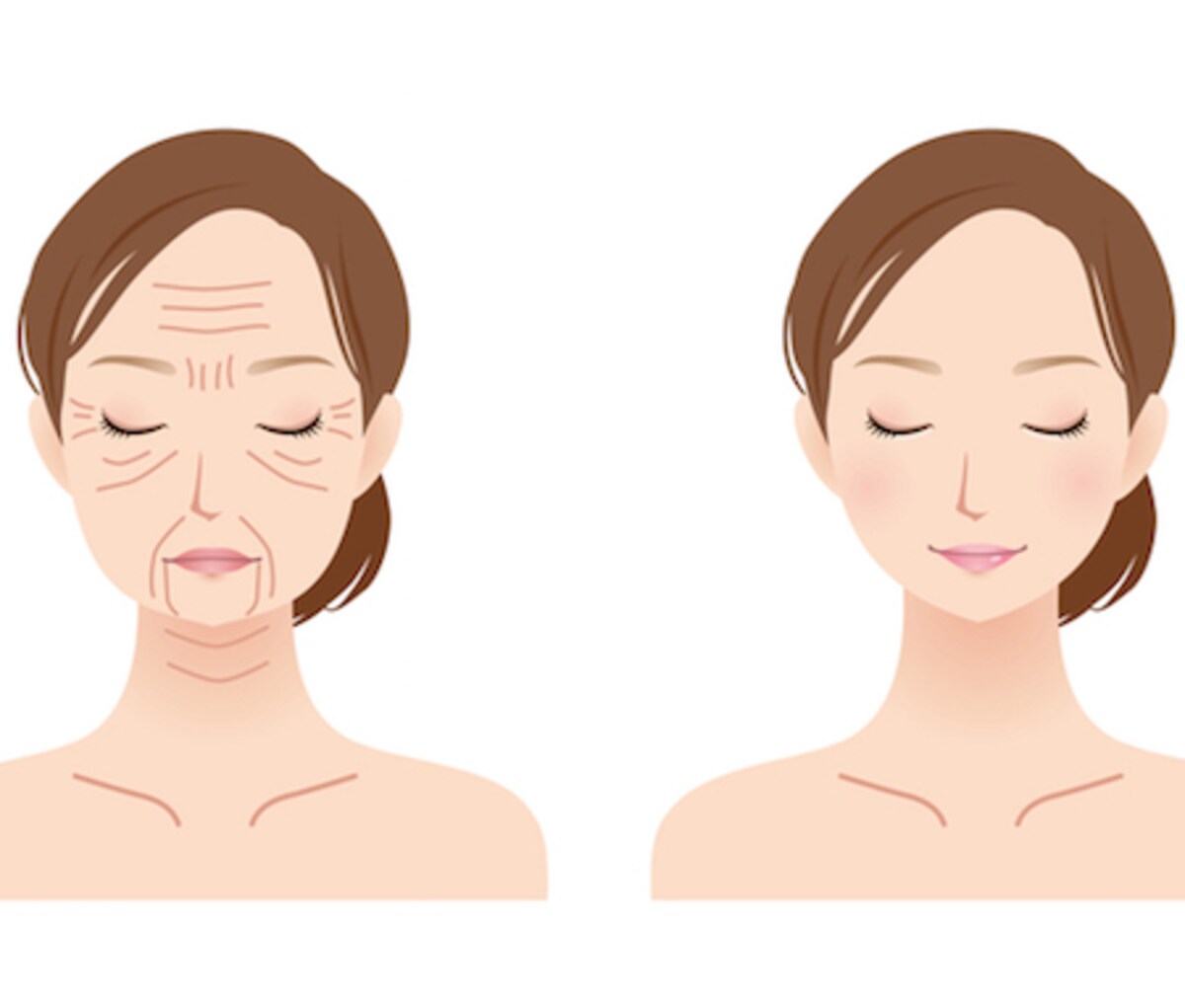 「ゴルゴ線」と呼ばれるミッドチークラインを目立たなくするには？