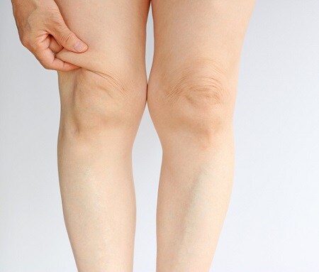 オバサン脚の原因?! もたつくひざ周りをスッキリさせて脚ヤセ!