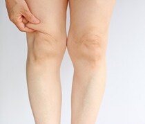 オバサン脚の原因?! もたつくひざ周りをスッキリさせて脚ヤセ！