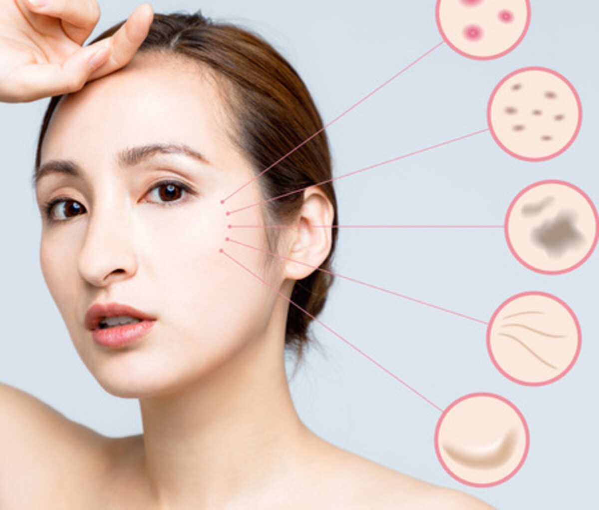 肝斑は何歳からできる？原因や皮膚科で受けられるおすすめのケア方法