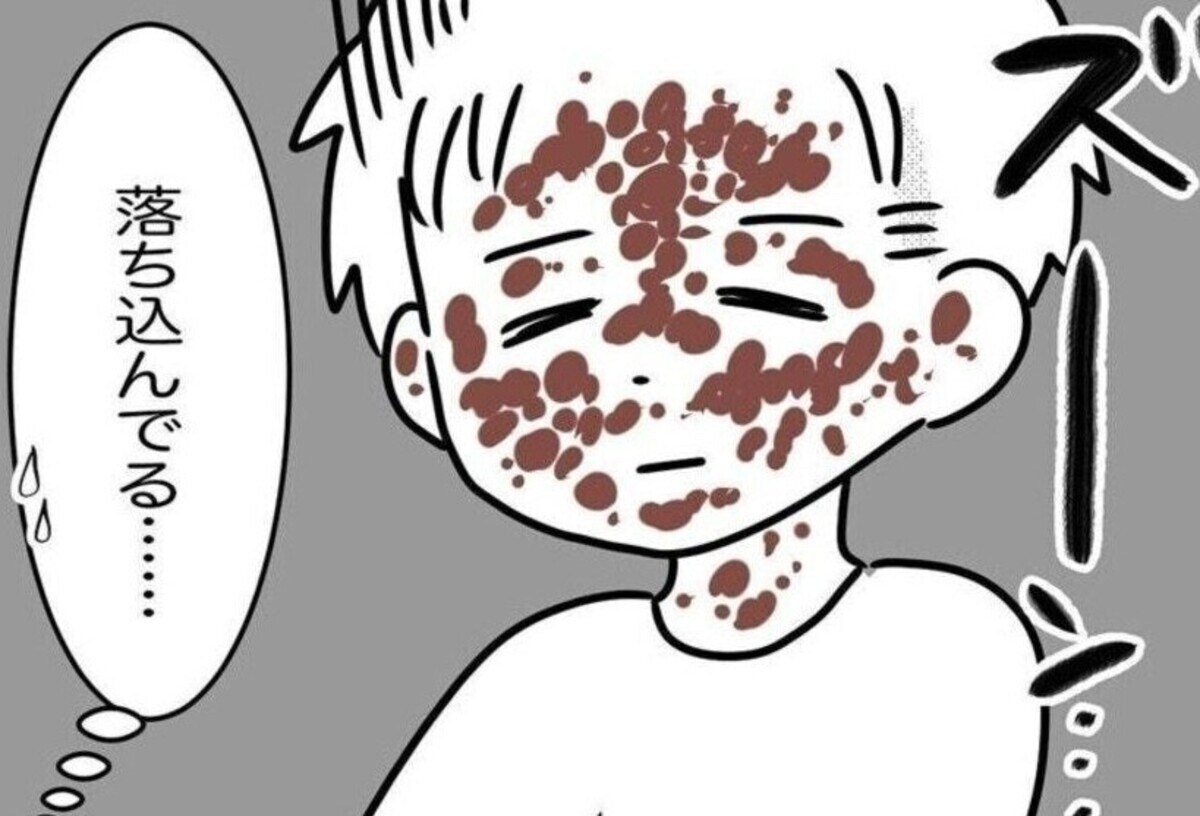 手足口病は子どもだけの病気じゃなかった…発疹だらけになった夫の体験を漫画化