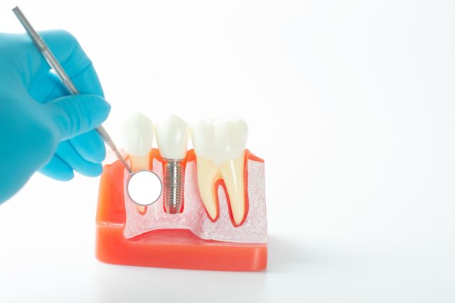 「インプラント周囲炎」の対処法はご存じですか? 再治療の有無や予防のポイントも歯科医が解説!