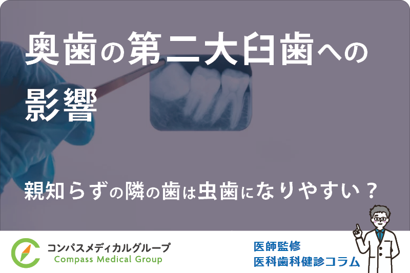 親知らずの隣の歯は虫歯になりやすい？ | 奥歯の第二大臼歯への影響