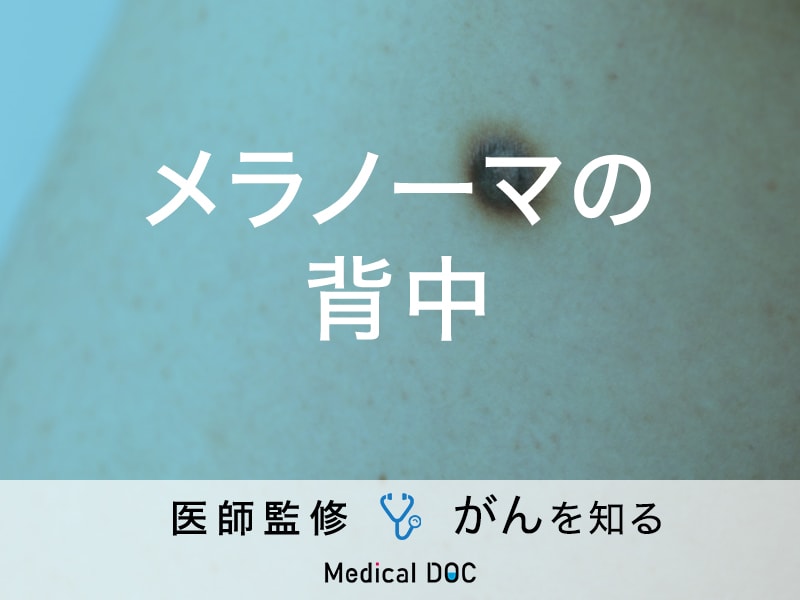 「背中」にできる「メラノーマ」の症状はご存知ですか？好発年齢も解説！