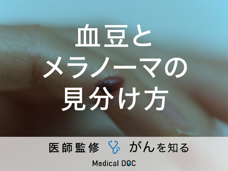 「血豆とメラノーマの見分け方」はご存知ですか？メラノーマの治療法も解説！