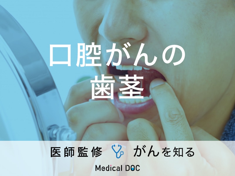 「歯茎にできる口腔がん・歯肉がん」の症状・治療法はご存知ですか？【医師監修】