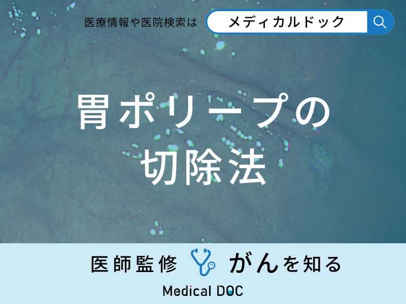 「胃ポリープの切除法」はご存知ですか？切除後の食事についても医師が徹底解説！