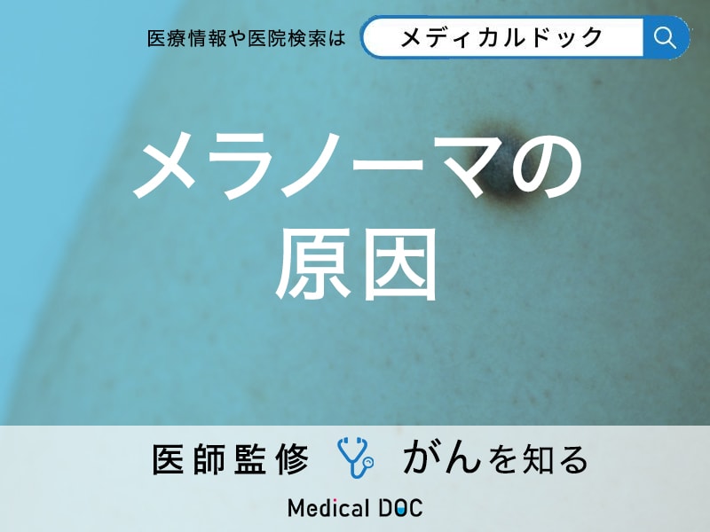 「メラノーマの原因」はご存知ですか？なりやすい人の特徴も解説！【医師監修】