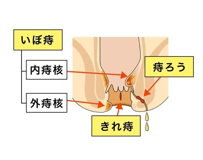 意外と多い！？産後ママのおしりの痛みやトラブルには早めの対処をの画像9