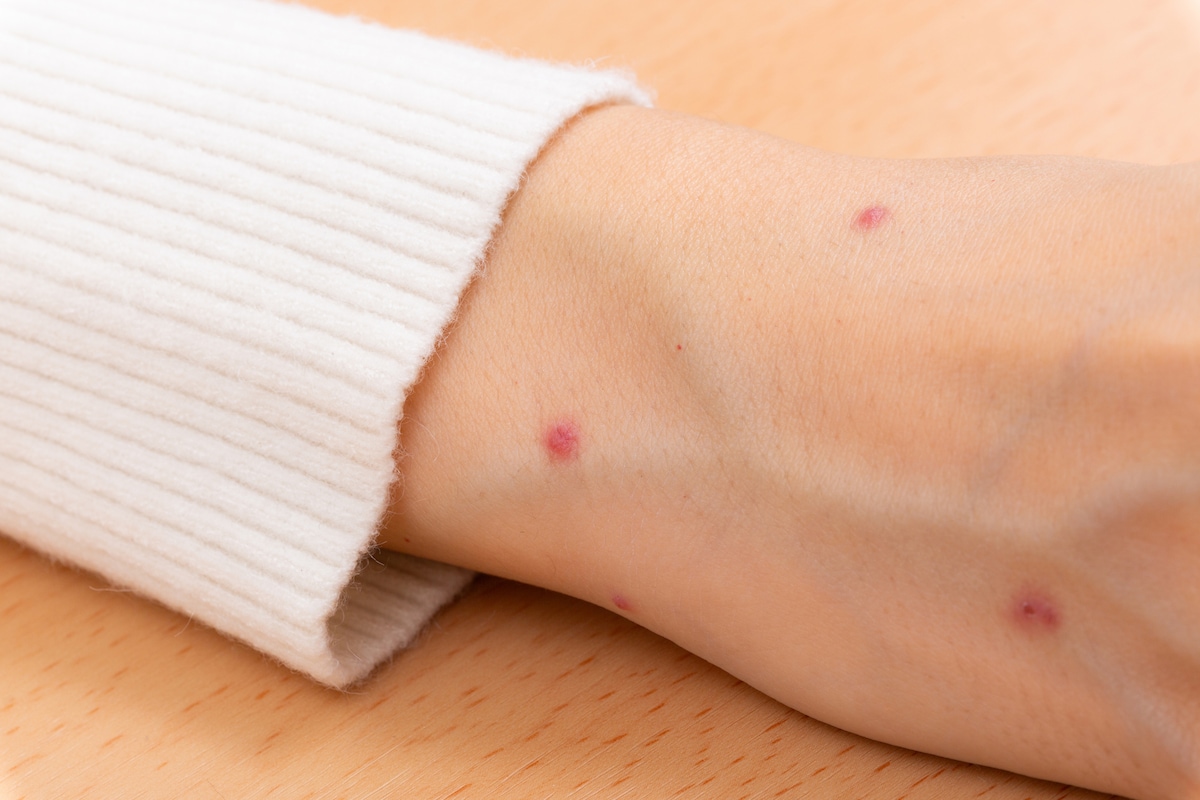 放置は命取り?皮膚の『赤い点』の恐怖。 立川志らくが語る『バセドウ病』の真実と失明を招く“網膜剥離”の予防法