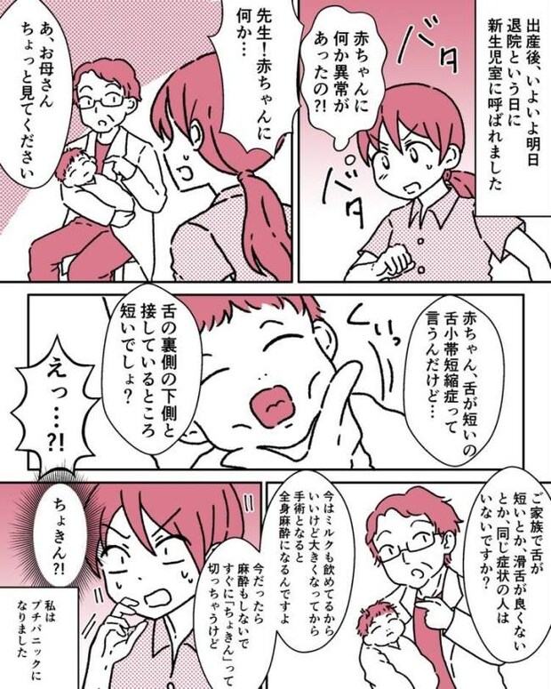 舌小帯短縮症　体験談マンガ