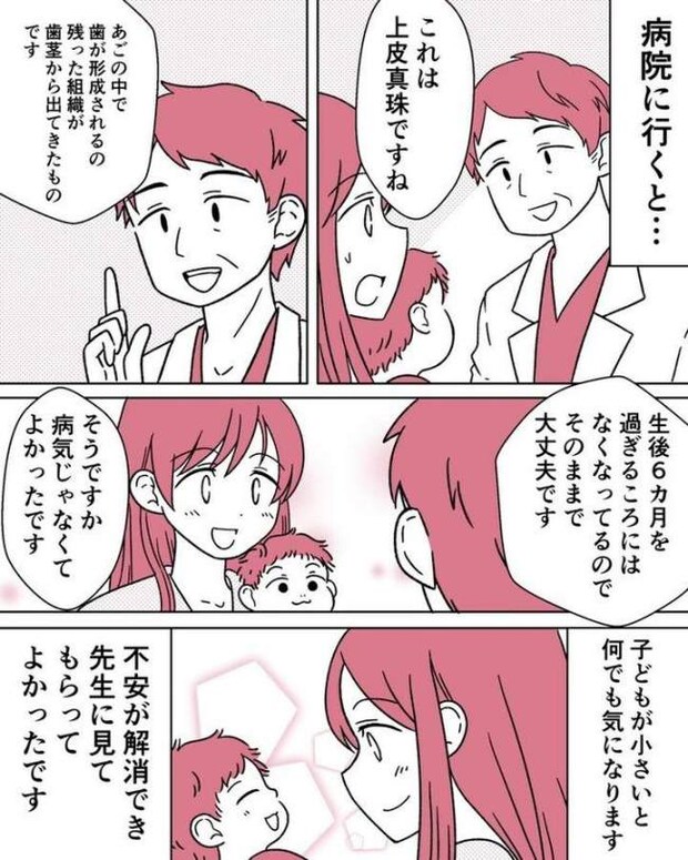 上皮真珠 体験談マンガ化