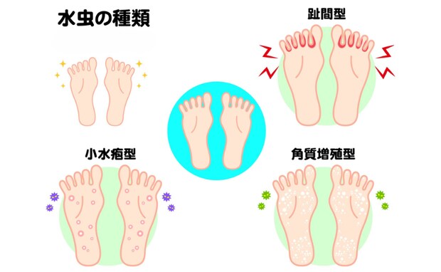 50代からは皮膚感染症に注意!「帯状疱疹」や「水虫」はうつる?家庭内で予防するポイントは【医師解説】