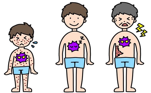 50代からは皮膚感染症に注意!「帯状疱疹」や「水虫」はうつる?家庭内で予防するポイントは【医師解説】