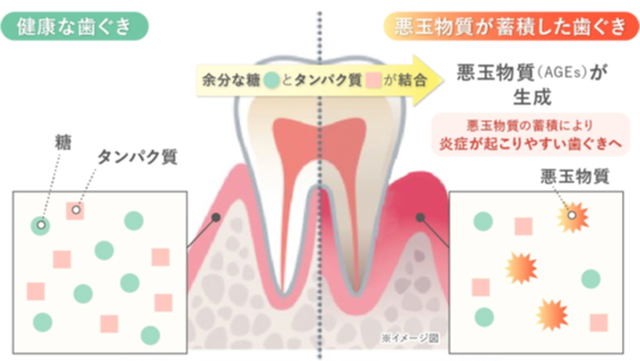 悪玉物質「AGEs（終末糖化産物）」が蓄積した歯ぐき