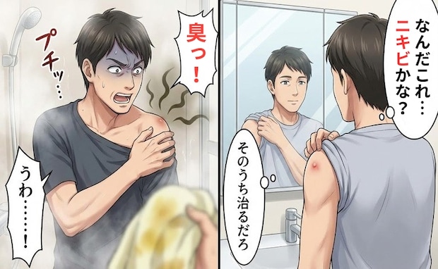 プチッ…「臭っ!」シャワー中に漂う異臭と黄色いシミ。左肩のできものを放置して招いた事態【体験談】