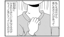 手術はまさかの10分？ 気になる首の「赤ボクロ」。思い切って皮膚科で除去することに／マダム60