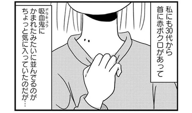 手術はまさかの10分？ 気になる首の「赤ボクロ」。思い切って皮膚科で除去することに／マダム60