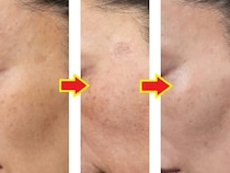 【体験ルポ】気になるシミ・肝斑……50代読者モデルのビフォー・アフター