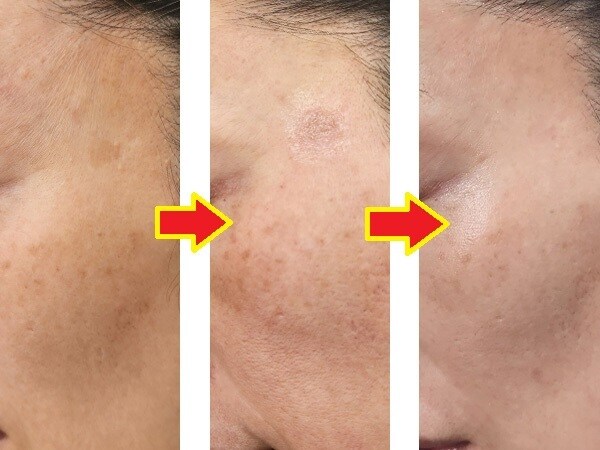 【体験ルポ】気になるシミ・肝斑……50代読者モデルのビフォー・アフター