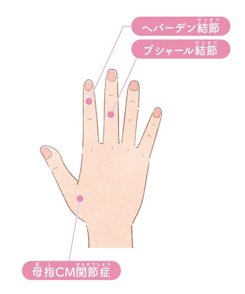 セルフチェック1：「ヘパーデン結節」「ブシャール結節」「母子CM関節症」