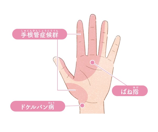 セルフチェック2:「ばね指」「ドケルバン病」「手根管症候群」