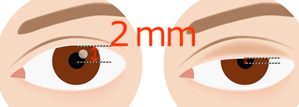 黒目の中心から上瞼のふちまでの距離が2㎜以下になっているかチェックを