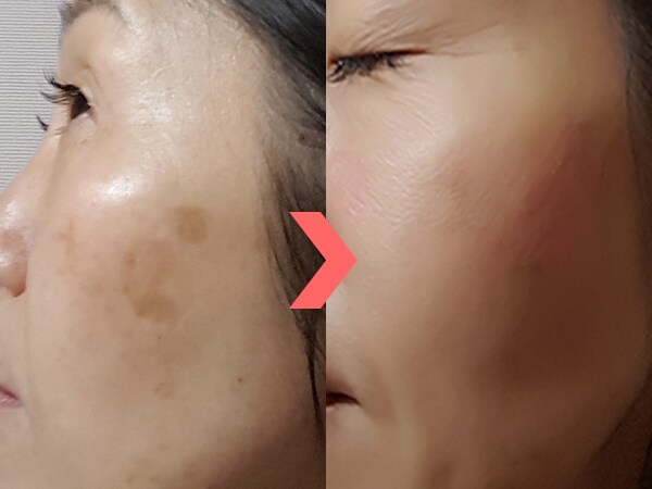 シミ取りレーザー体験