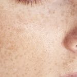 そばかす（雀卵斑）