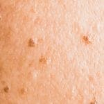 脂漏性角化症（老人性イボ）