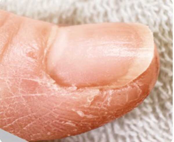 【乾燥】ささくれに悪化する前に!原因&ケア方法