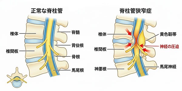 脊柱管狭窄症