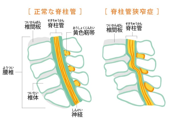 50代から増える脊柱管狭窄症。どんな病気？