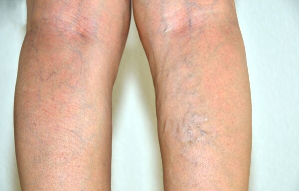 脚が重い、血管浮き「下肢静脈瘤」
