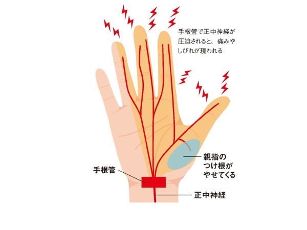 手指の病気3「手根管症候群」