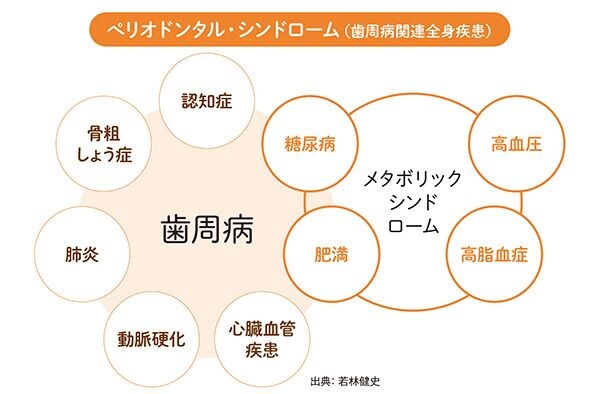 ぺリオドンタル・シンドローム（歯周病関連全身疾患）