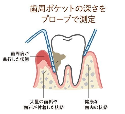 歯周ポケットにプロープを挿入して深さを測る