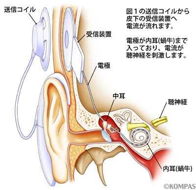 人工内耳画像