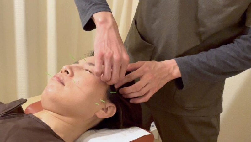 顔面に鍼を打つ様子