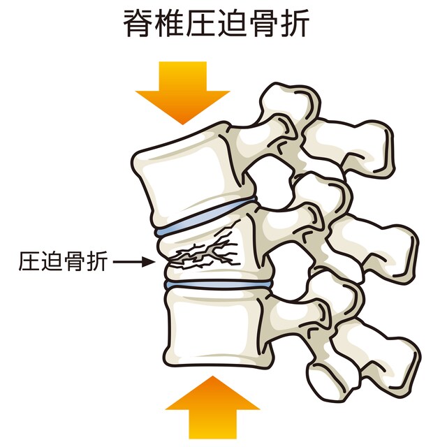 圧迫骨折のイメージ Image by PIXTA