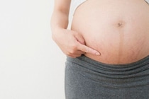 【産科医に聞く！】“妊娠線”ってなぜできるの？　できたらどうなる？